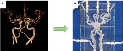 A Review of the Advancements in the in-vitro Modelling of Acute Ischemic Stroke and Its Treatment